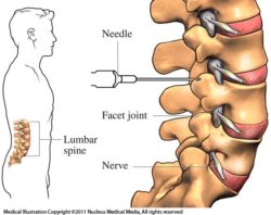 spinal facet injections